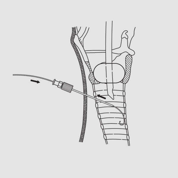 Devg2 Educational resources – Blue Rhino® G2-Multi | Cook Medical